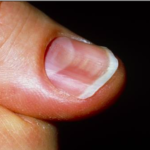 さじ状爪（spoon nail）。鉄欠乏性貧血では中央が陥没した爪の形になる。