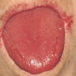 plummer vinson症候群。口角炎や舌炎（赤い舌）となる。嚥下障害を合併することもある。