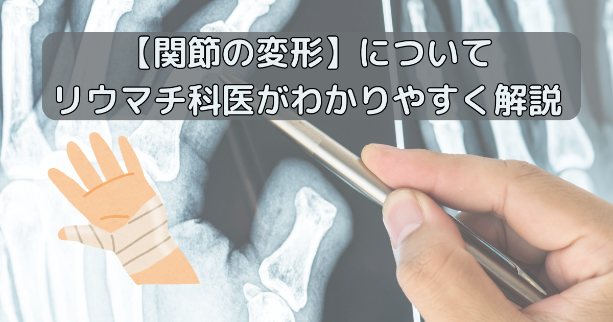 関節が変形する主な原因には、変形性関節症、ばね指、関節リウマチなどがあります。変形性関節症では、骨がゴツゴツと出っ張り、手の指の第1関節に起こることが多いです。関節リウマチでは、関節が柔らかく腫れ、第1関節に炎症を起こさないことが特徴です。手足の変形を認めた場合は、リウマチ科、膠原病内科や整形外科で調べてもらいましょう。